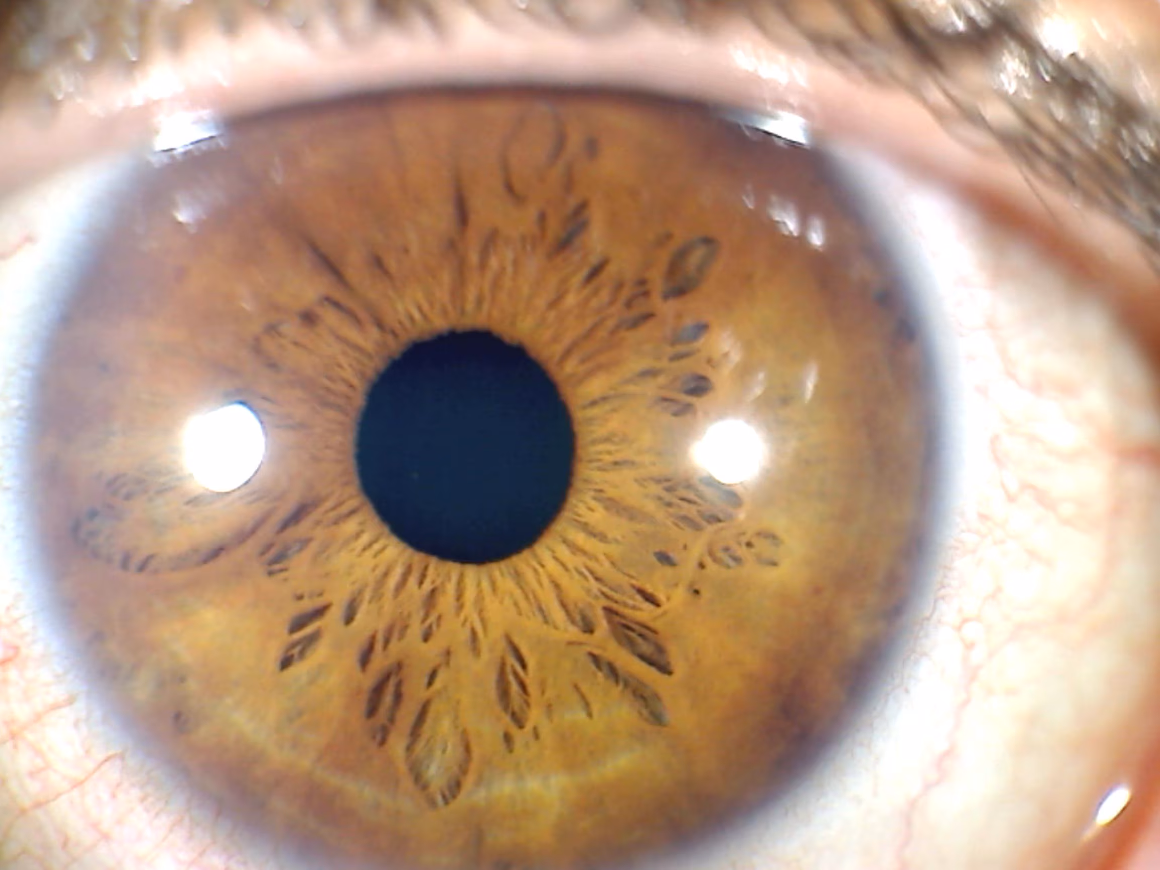 iris derecho, Iris izquierdo